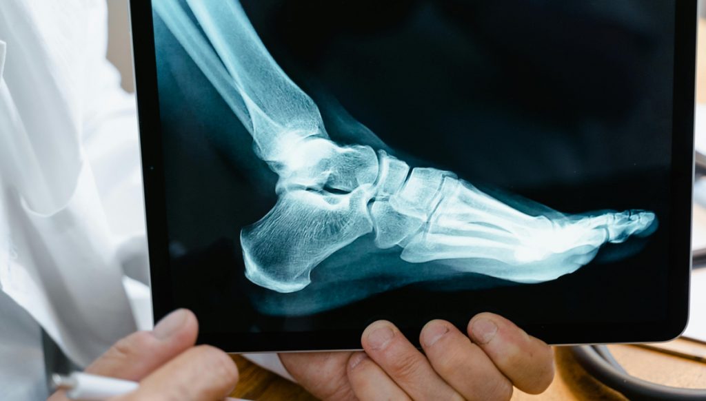 Ferse in der Röntgenansicht