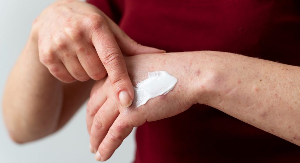 Cremes gegen Bluterguss